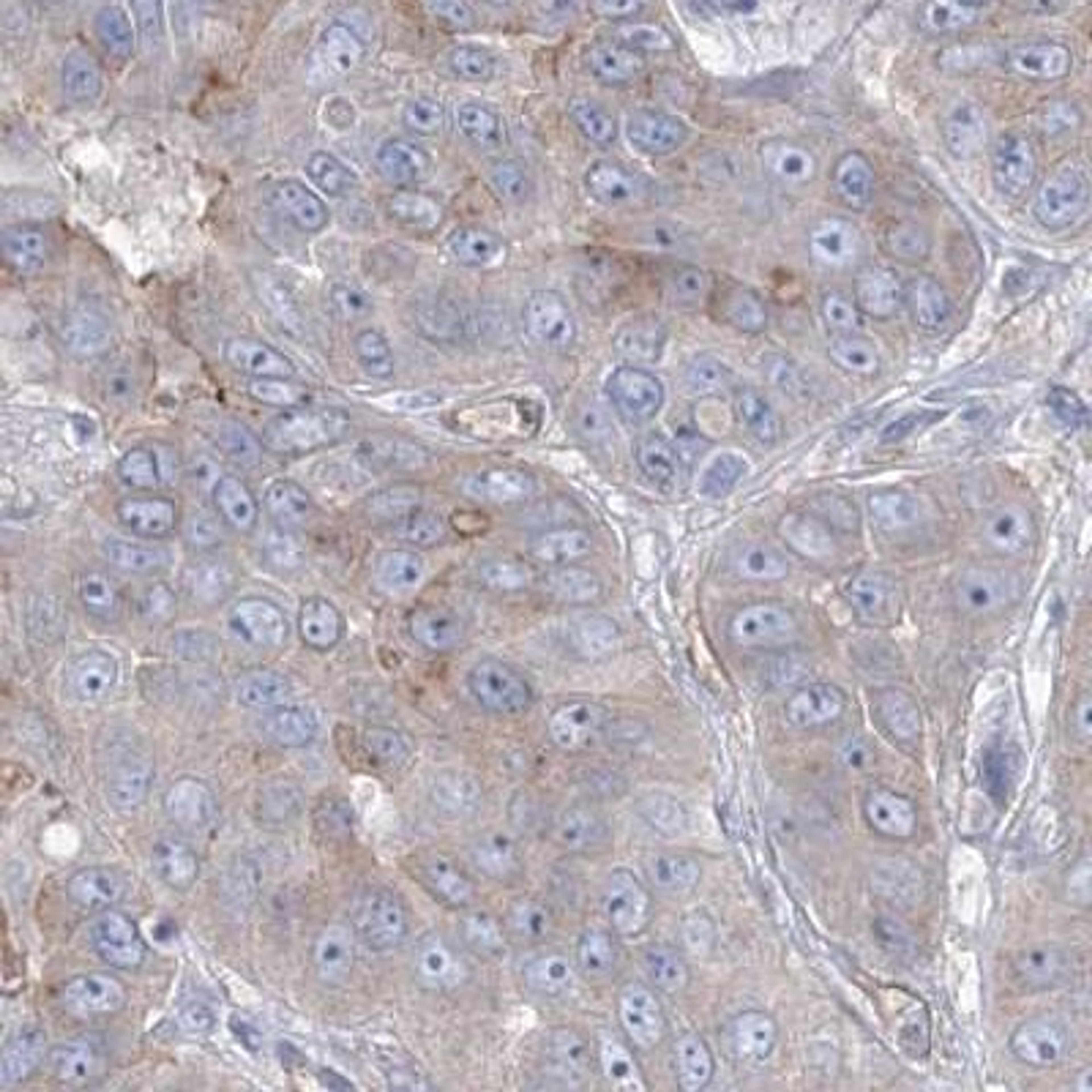 Immunohistochemistry: RAB11FIP5 Antibody [NBP2-32662] - liver cancer