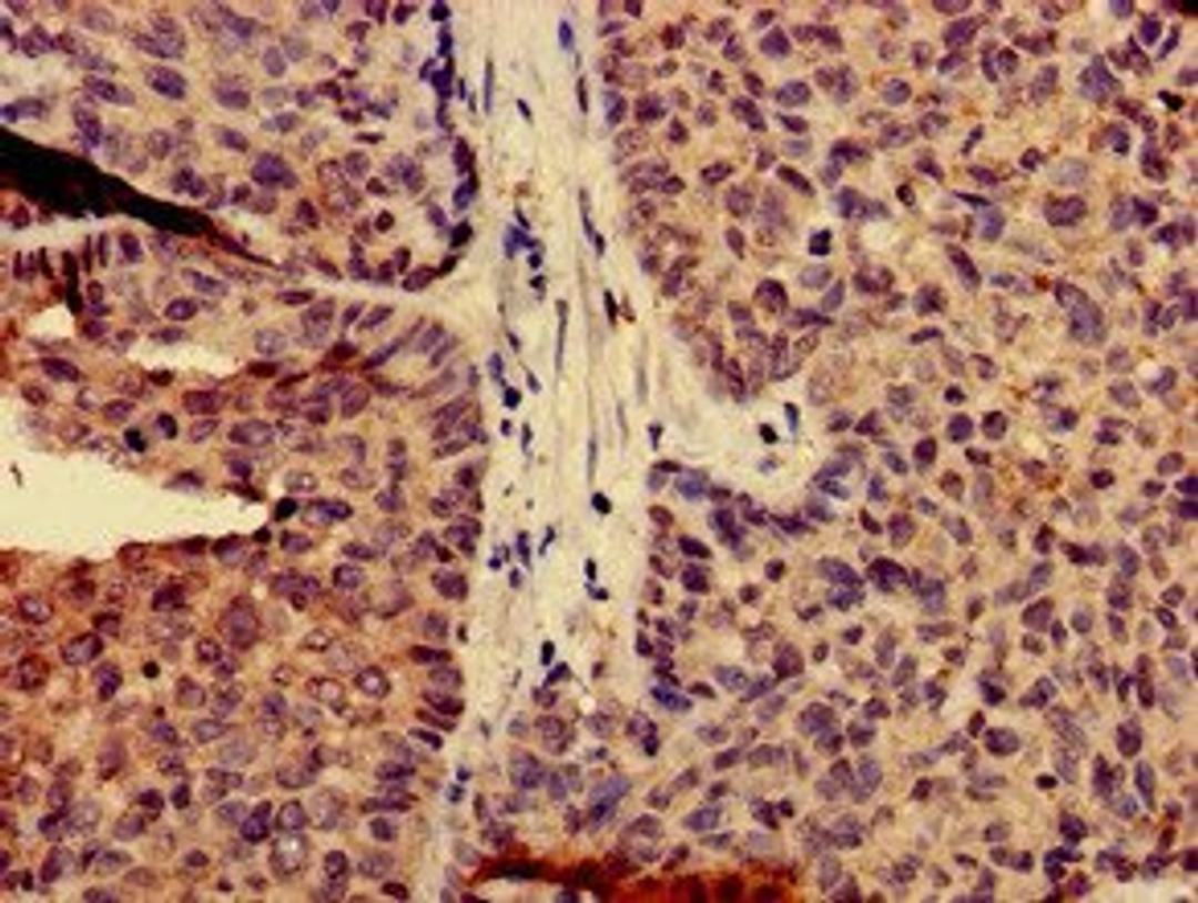 Immunohistochemical staining of human ovarian cancer using CAPN14 antibody