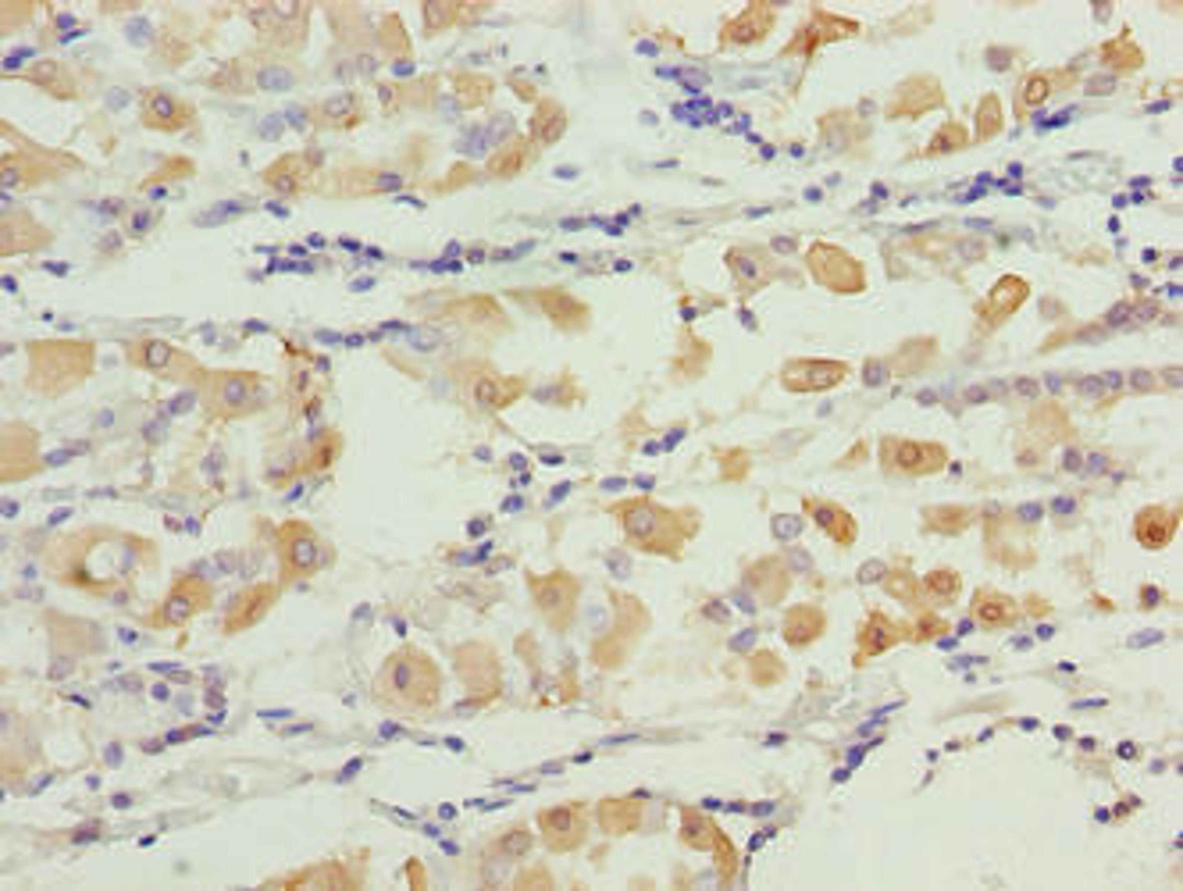 Immunohistochemistry of paraffin-embedded human gastric cancer using CSB-PA773032LA01HU at dilution of 1:100