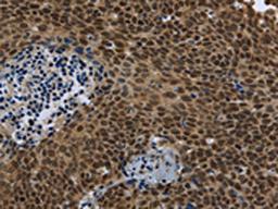 The image is immunohistochemistry of paraffin-embedded Human cervical cancer tissue using CSB-PA948107(SMAD4 Antibody) at dilution 1/40. (Original magnification: ×200)