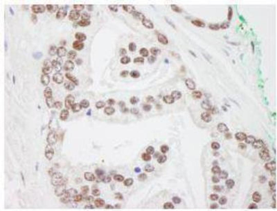 Immunohistochemistry-Paraffin: PRMT1 Antibody [NB100-2251] - FFPE section of human prostate adenocarcinoma.  Antibody used at a dilution of 1:250.