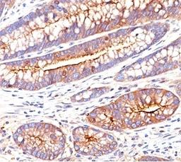 IHC testing of human colon carcinoma stained with CEA antibody (C66/261).