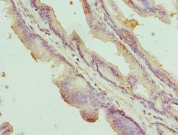 Immunohistochemistry of paraffin-embedded human prostate cancer using CSB-PA138304ESR2HU at dilution of 1:100