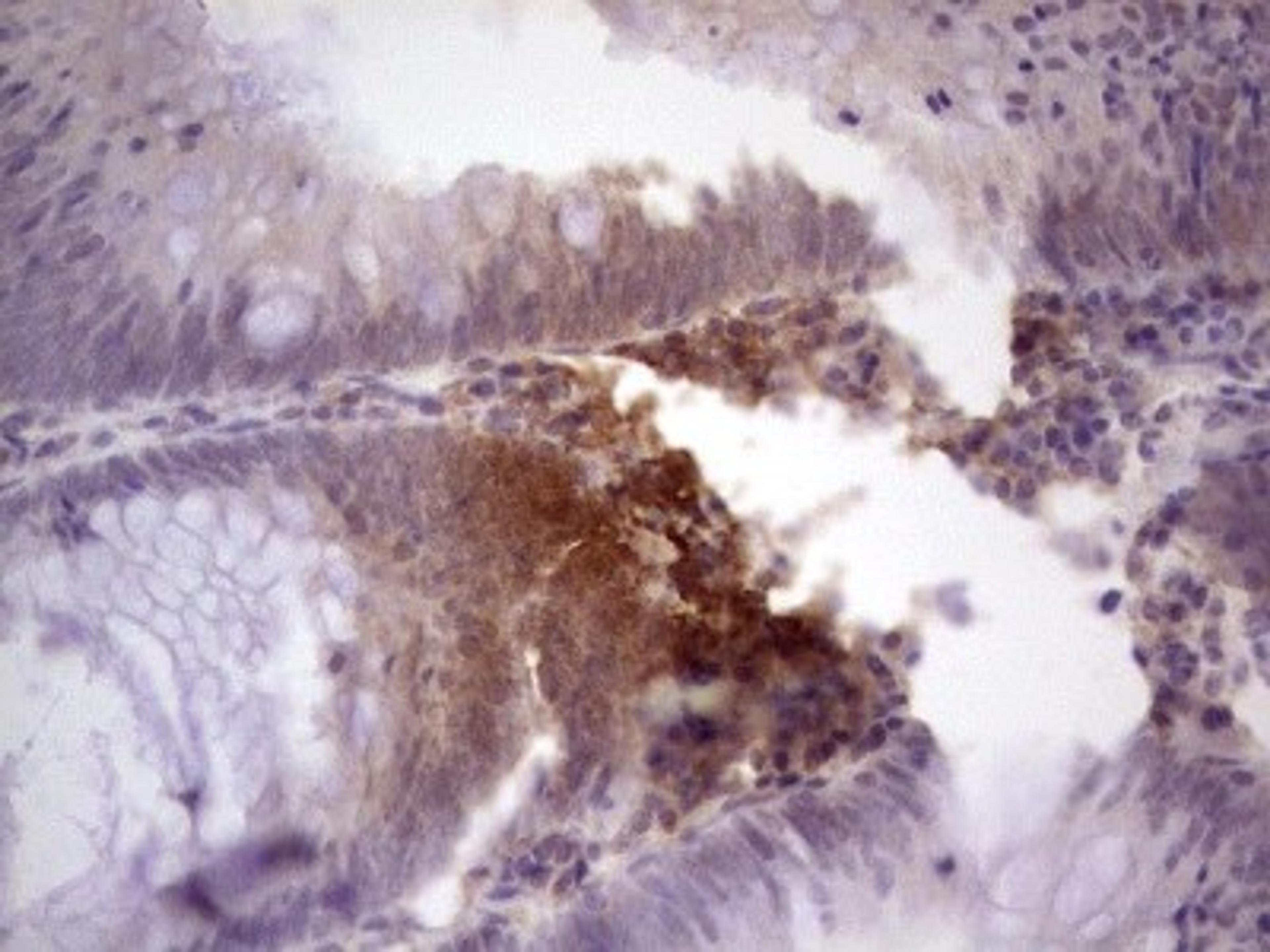 Immunohistochemistry: TCF-12/HTF4 Antibody (4D6) [NBP2-46086] - Analysis of Adenocarcinoma of Human colon tissue. (Heat-induced epitope retrieval by 1 mM EDTA in 10mM Tris, pH8.5, 120C for 3min)