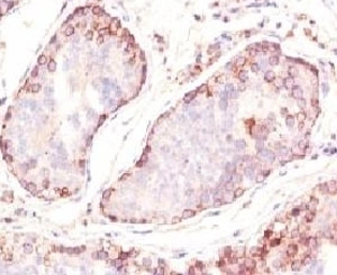 Formalin-fixed, paraffin-embedded human testicular carcinoma stained with MAGE-1 antibody (MZ2E/838).