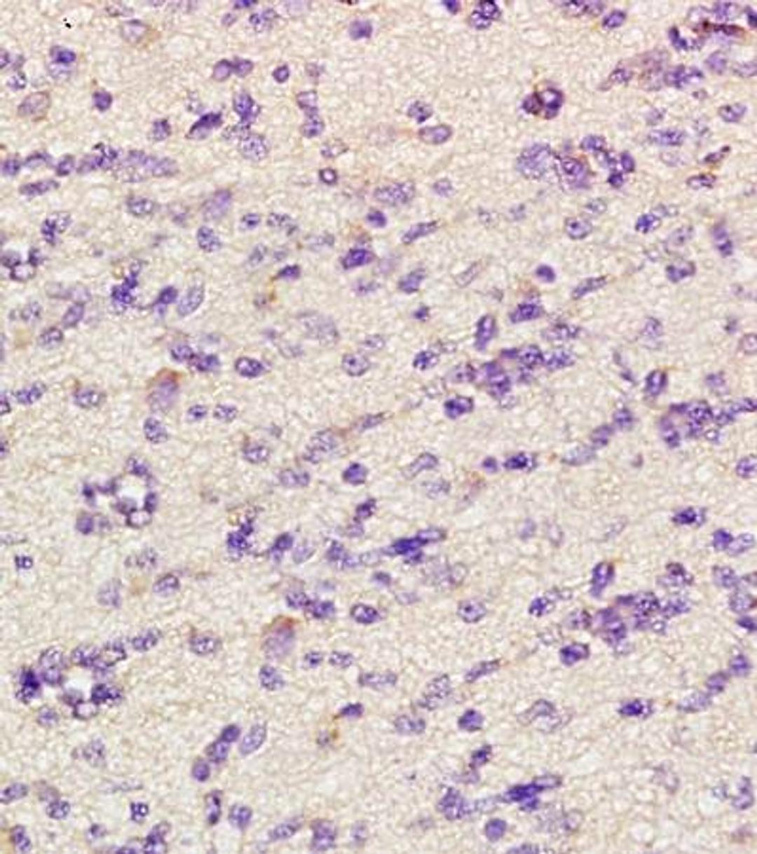 IHC-P of human glioma tissue (CHRNA4 antibody at 1:300)