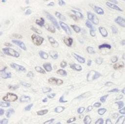 Detection of human Topo II Alpha by immunohistochemistry.