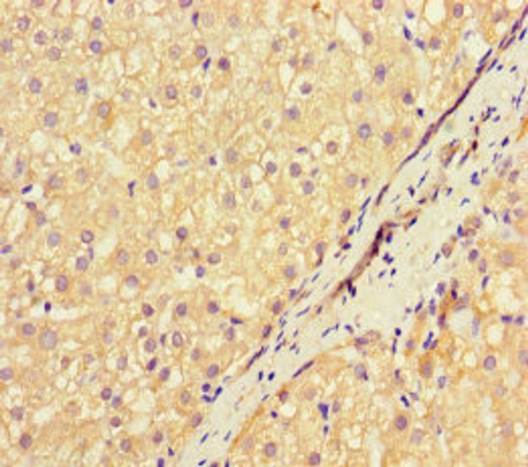 Immunohistochemistry of paraffin-embedded human liver cancer using CSB-PA17249A0Rb at dilution of 1:100