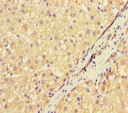 Immunohistochemistry of paraffin-embedded human liver cancer using CSB-PA17249A0Rb at dilution of 1:100