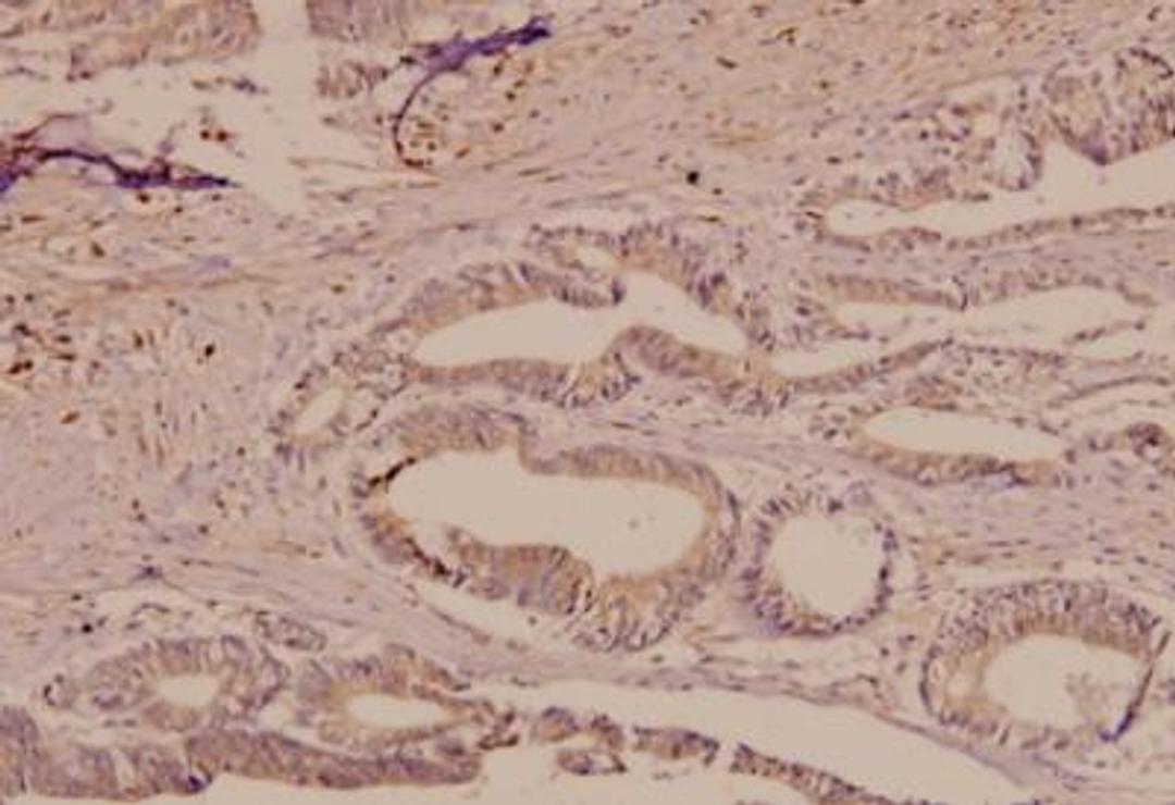 Immunohistochemistry-Paraffin: TfR (Transferrin R) Antibody [NB100-92243] - Paraffin-embedded human colorectal carcinoma tissue at 1:50.