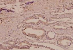 Immunohistochemistry-Paraffin: TfR (Transferrin R) Antibody [NB100-92243] - Paraffin-embedded human colorectal carcinoma tissue at 1:50.