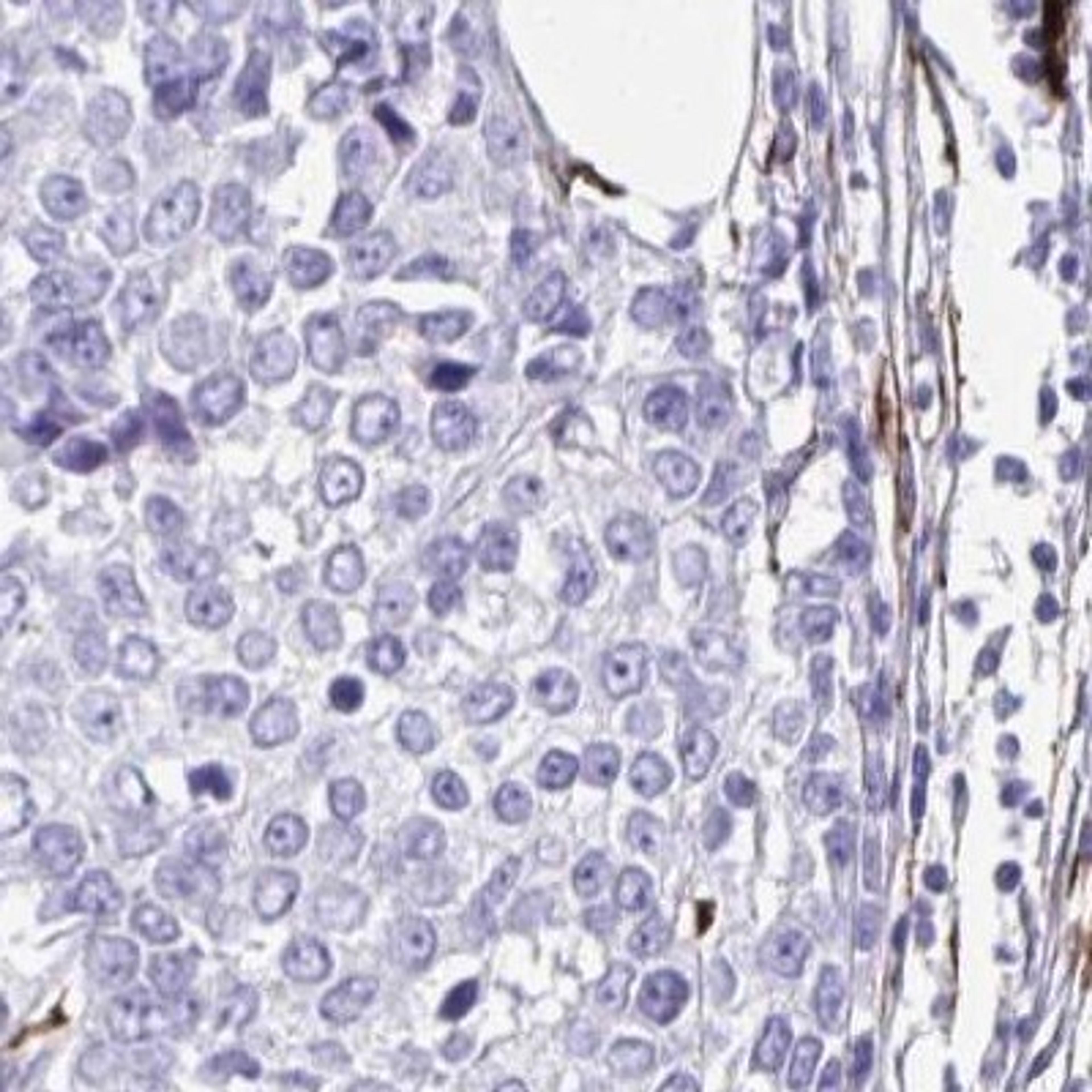 Immunohistochemistry: GRXCR2 Antibody [NBP2-32458] - breast cancer