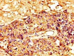 IHC image of CSB-PA10159A0Rb diluted at 1:300 and staining in paraffin-embedded human ovarian cancer performed on a Leica BondTM system. After dewaxing and hydration, antigen retrieval was mediated by high pressure in a citrate buffer (pH 6.0). Section was blocked with 10% normal goat serum 30min at RT. Then primary antibody (1% BSA) was incubated at 4°C overnight. The primary is detected by a biotinylated secondary antibody and visualized using an HRP conjugated SP system.