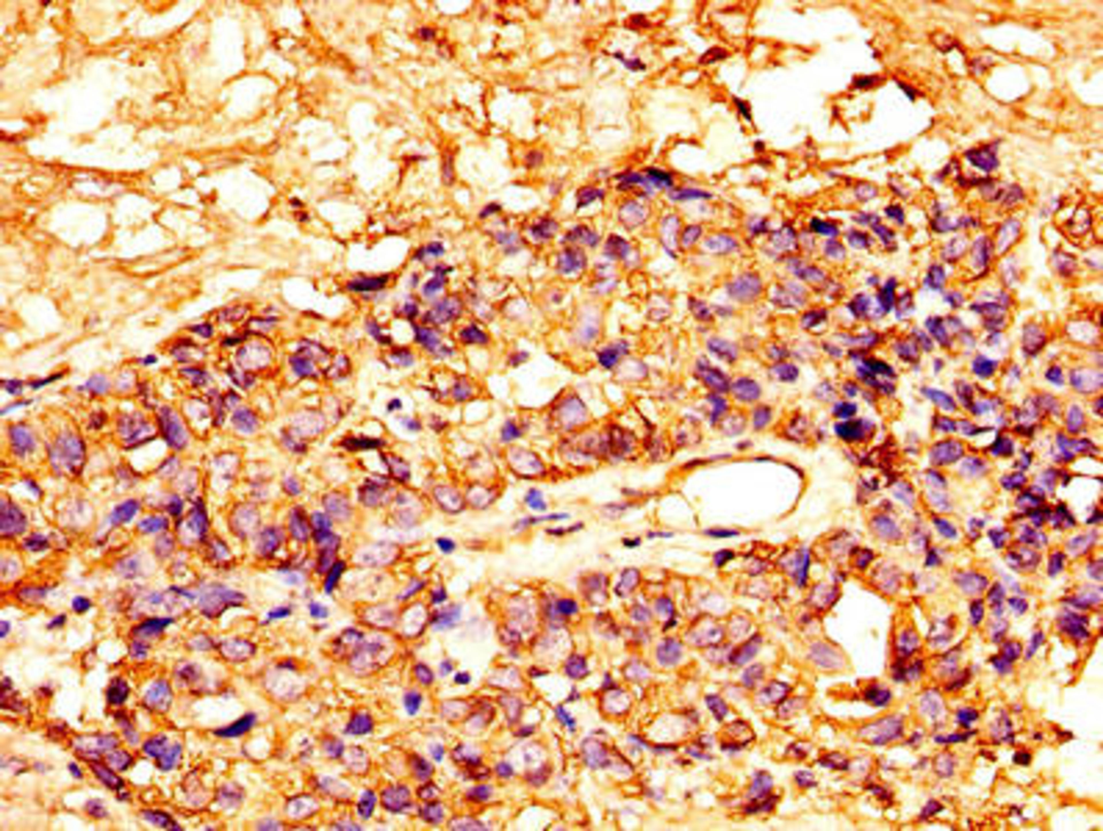 IHC image of CSB-PA10159A0Rb diluted at 1:300 and staining in paraffin-embedded human ovarian cancer performed on a Leica BondTM system. After dewaxing and hydration, antigen retrieval was mediated by high pressure in a citrate buffer (pH 6.0). Section was blocked with 10% normal goat serum 30min at RT. Then primary antibody (1% BSA) was incubated at 4°C overnight. The primary is detected by a biotinylated secondary antibody and visualized using an HRP conjugated SP system.