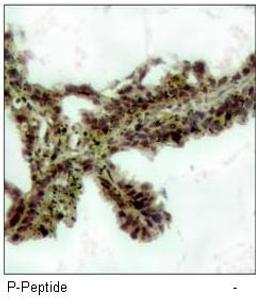 Immunohistochemical analysis of paraffin-embedded human lung carcinoma tissue, using Akt (phospho-Thr308) antibody