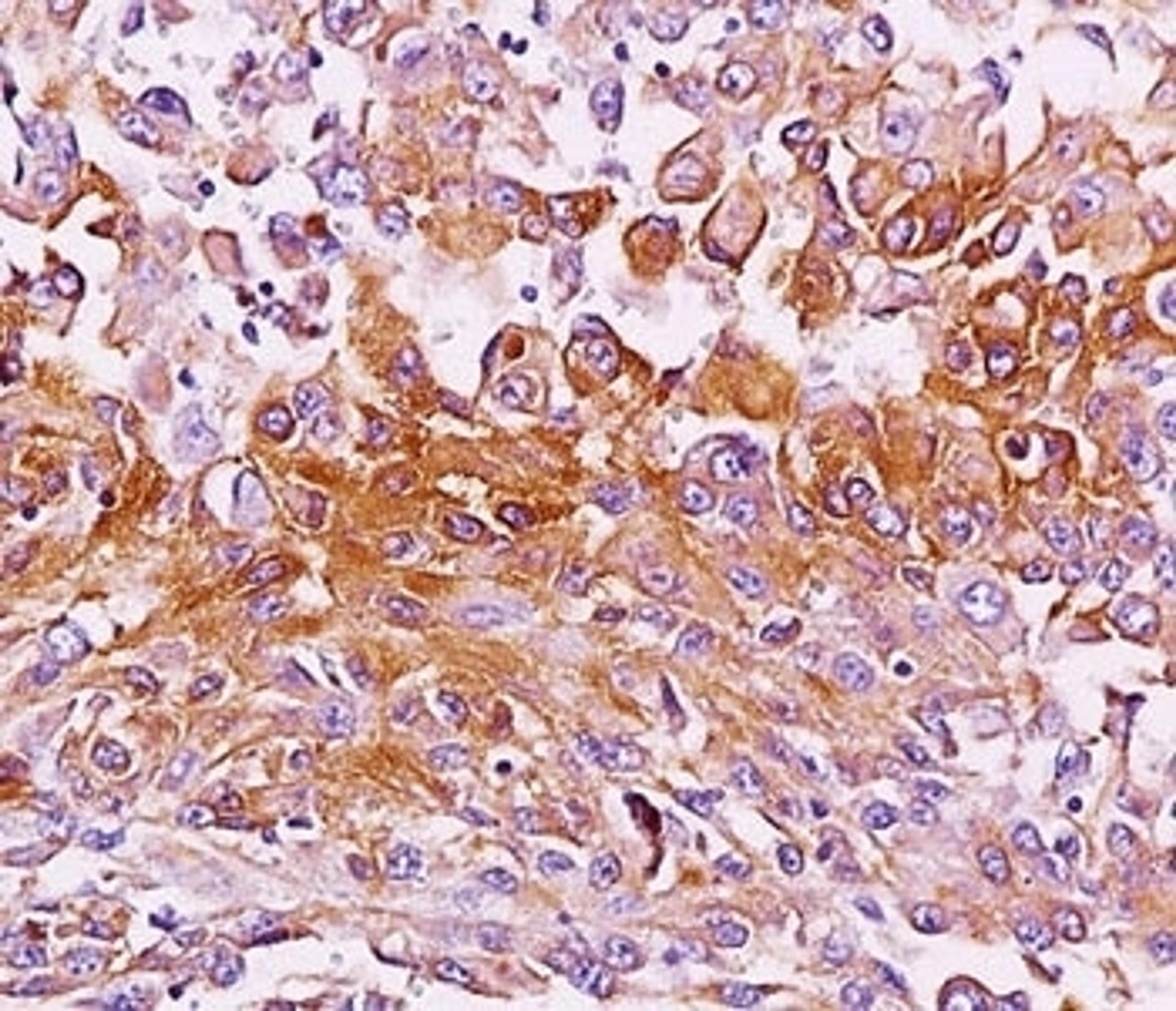 IHC testing of melanoma tissue stained with Melanoma antibody (NKI-beteb).