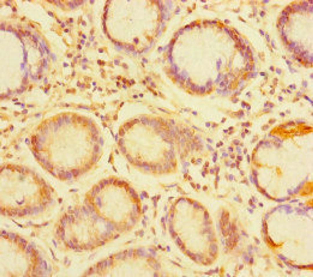 Immunohistochemistry of paraffin-embedded human gastric cancer using CSB-PA874834LA01HU at dilution of 1:100