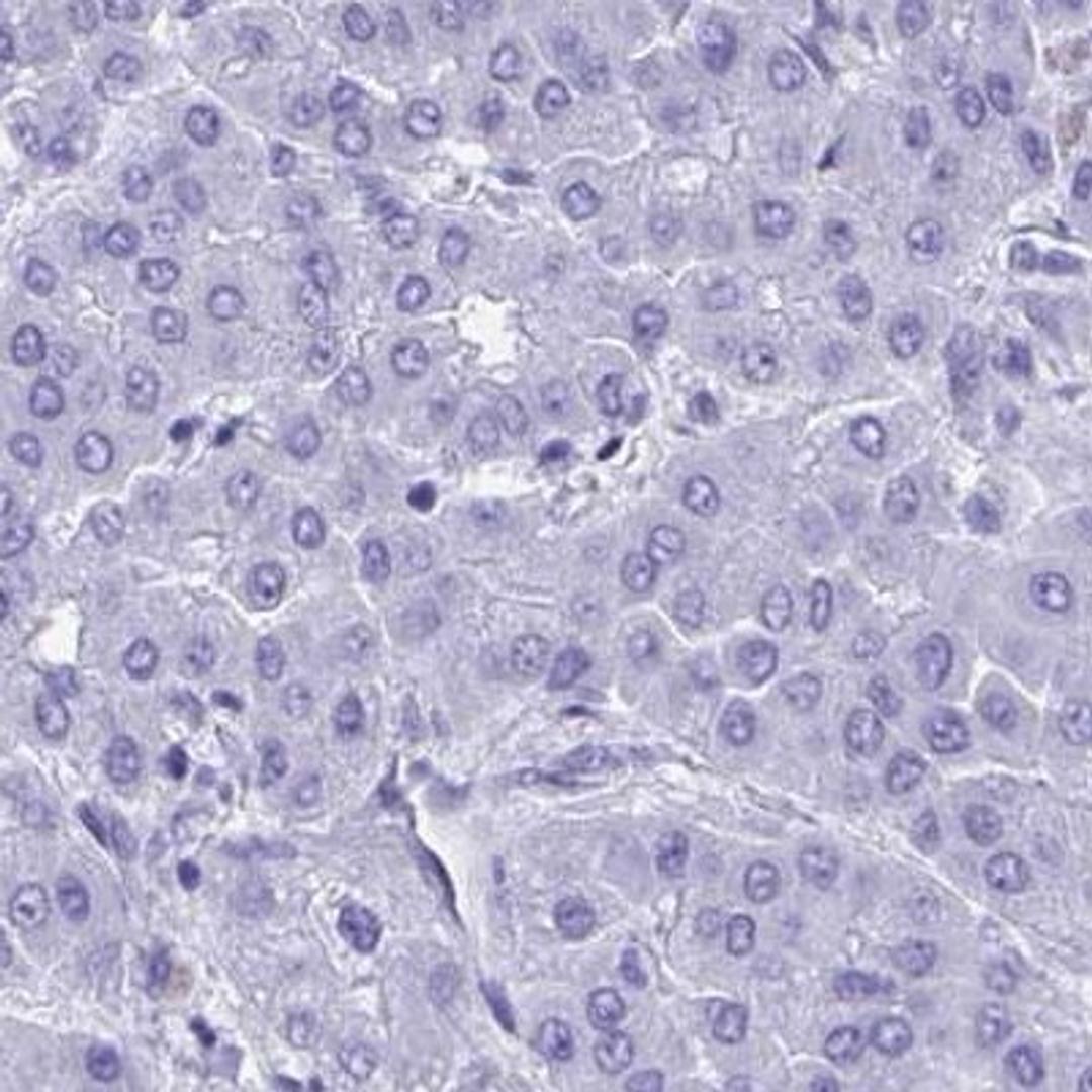 Immunohistochemistry: BEX5 Antibody [NBP2-32422] - liver cancer