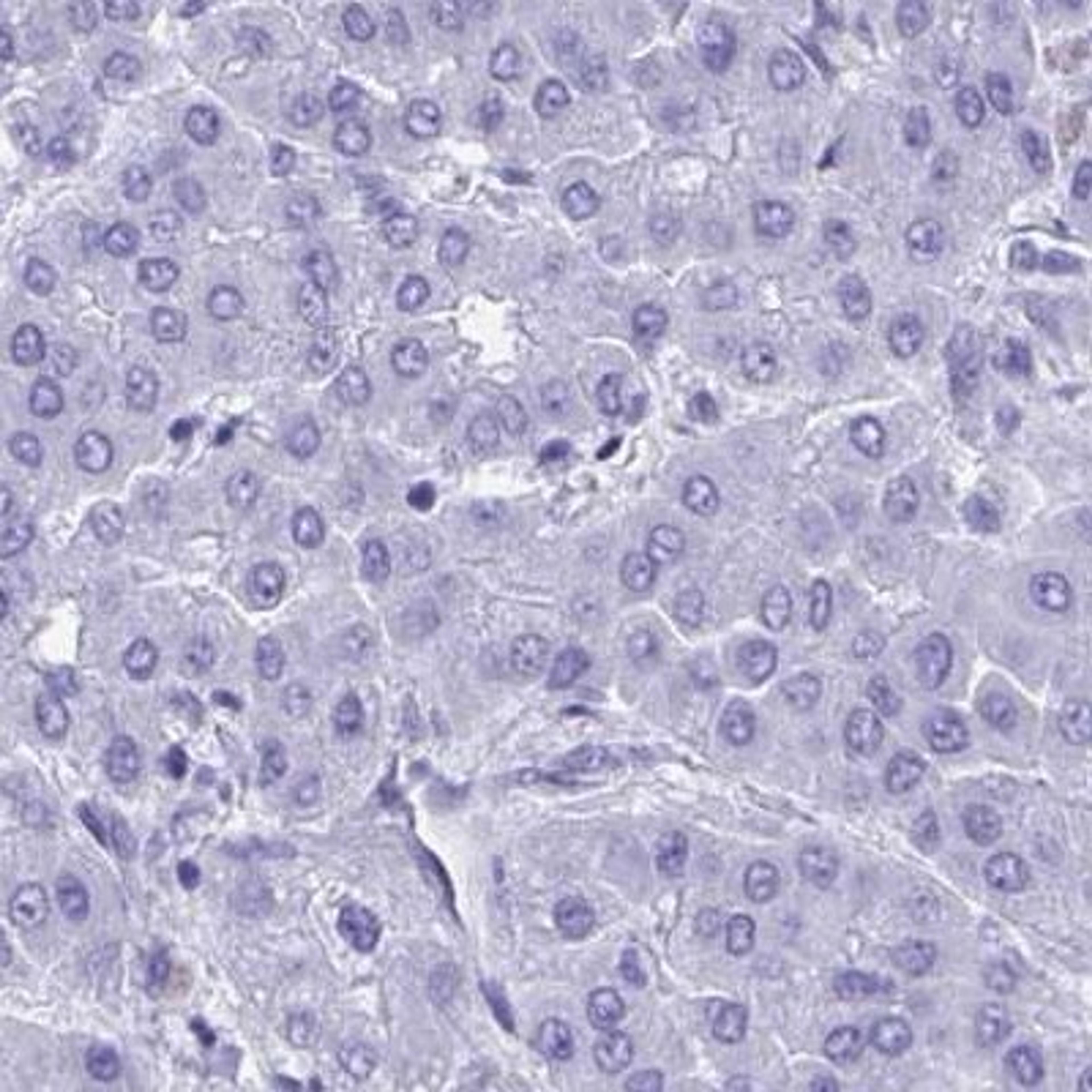 Immunohistochemistry: BEX5 Antibody [NBP2-32422] - liver cancer