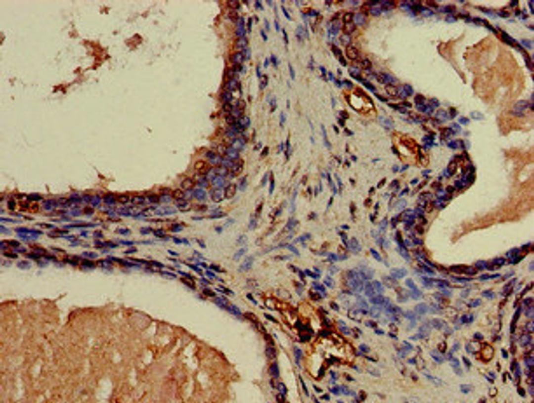 Immunohistochemistry of paraffin-embedded human prostate cancer using CSB-PA005657LA01HU at dilution of 1:100