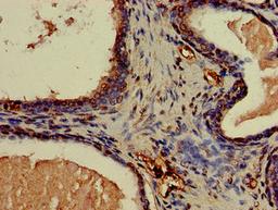 Immunohistochemistry of paraffin-embedded human prostate cancer using CSB-PA005657LA01HU at dilution of 1:100