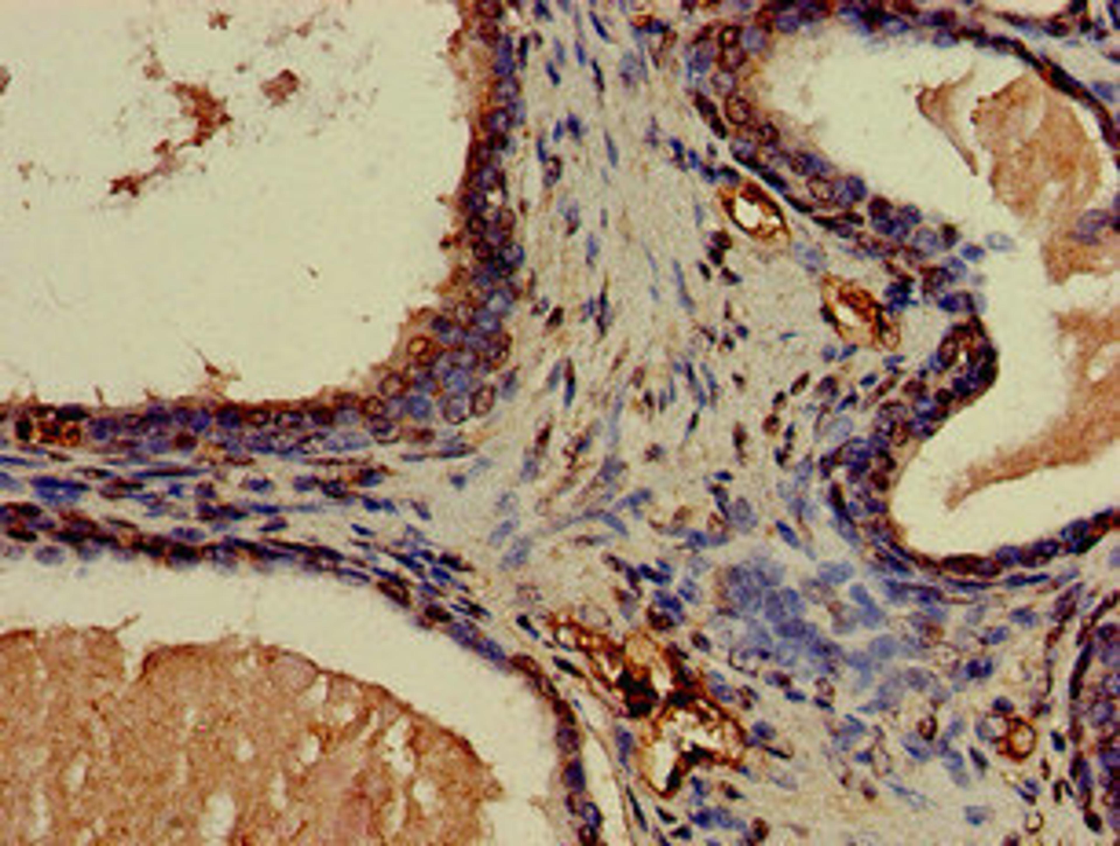 Immunohistochemistry of paraffin-embedded human prostate cancer using CSB-PA005657LA01HU at dilution of 1:100