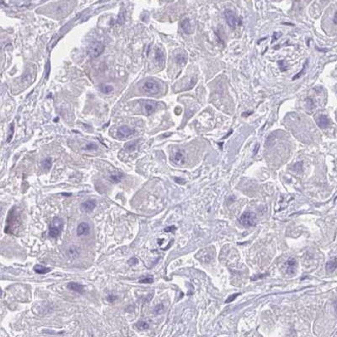 Immunohistochemistry: PIGZ Antibody [NBP2-32394] - liver cancer