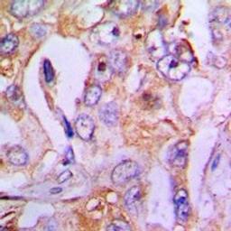 Immunohistochemical staining of human lung cancer tissue using HDC antibody