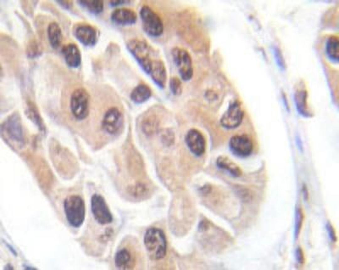 Immunohistochemistry-Paraffin: FOXO3 [p Ser253] Antibody [NBP1-19927] - Paraffin-embedded human breast carcinoma tissue.