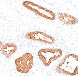 IHC testing of human prostate carcinoma stained with PSA antibody.