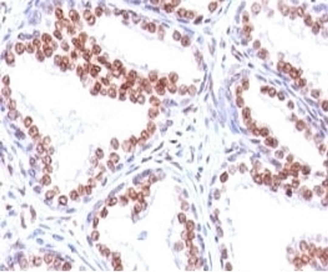 Formalin-fixed, paraffin-embedded human prostate carcinoma stained with anti-Androgen Receptor antibody (SPM335).