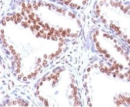 Formalin-fixed, paraffin-embedded human prostate carcinoma stained with anti-Androgen Receptor antibody (SPM335).