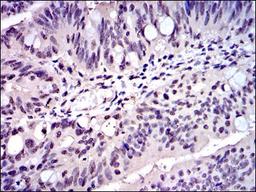 Immunohistochemistry: Skp1 Antibody (4E11) [NBP2-37539] - Immunohistochemical analysis of paraffin-embedded rectum cancer tissues using SKP1 mouse mAb with DAB staining.