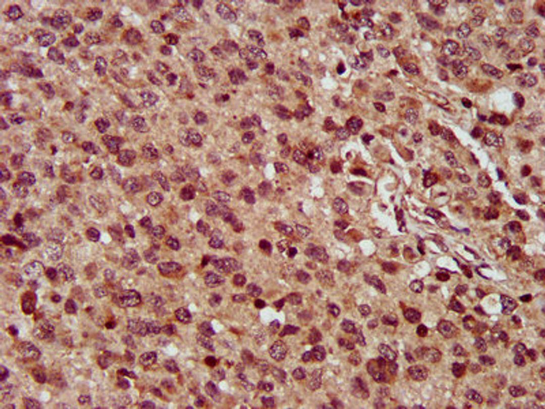 IHC image of CSB-PA875665LA01HU diluted at 1:300 and staining in paraffin-embedded human glioma performed on a Leica BondTM system. After dewaxing and hydration, antigen retrieval was mediated by high pressure in a citrate buffer (pH 6.0). Section was blocked with 10% normal goat serum 30min at RT. Then primary antibody (1% BSA) was incubated at 4&deg;C overnight. The primary is detected by a biotinylated secondary antibody and visualized using an HRP conjugated SP system.
