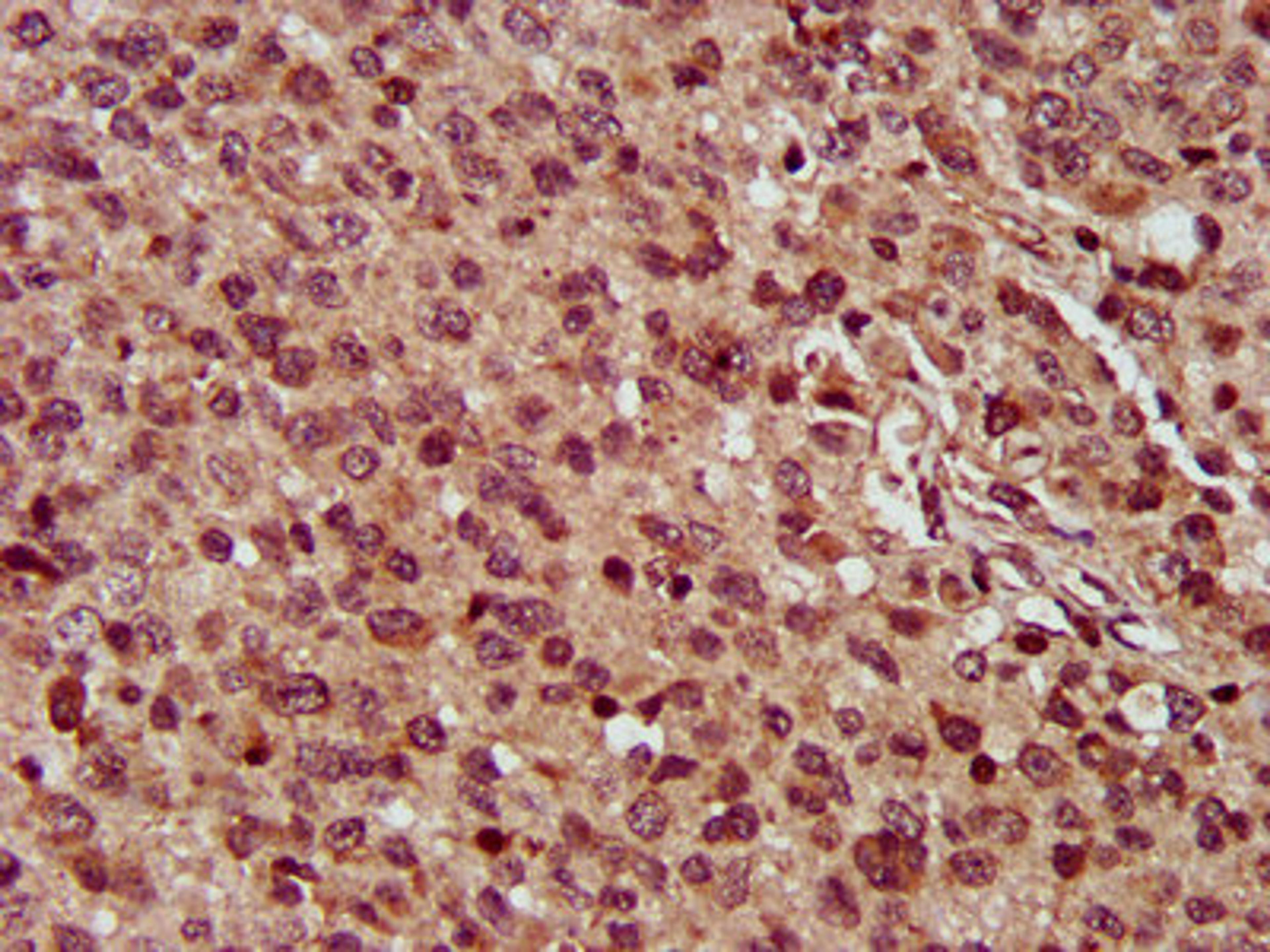 IHC image of CSB-PA875665LA01HU diluted at 1:300 and staining in paraffin-embedded human glioma performed on a Leica BondTM system. After dewaxing and hydration, antigen retrieval was mediated by high pressure in a citrate buffer (pH 6.0). Section was blocked with 10% normal goat serum 30min at RT. Then primary antibody (1% BSA) was incubated at 4&deg;C overnight. The primary is detected by a biotinylated secondary antibody and visualized using an HRP conjugated SP system.