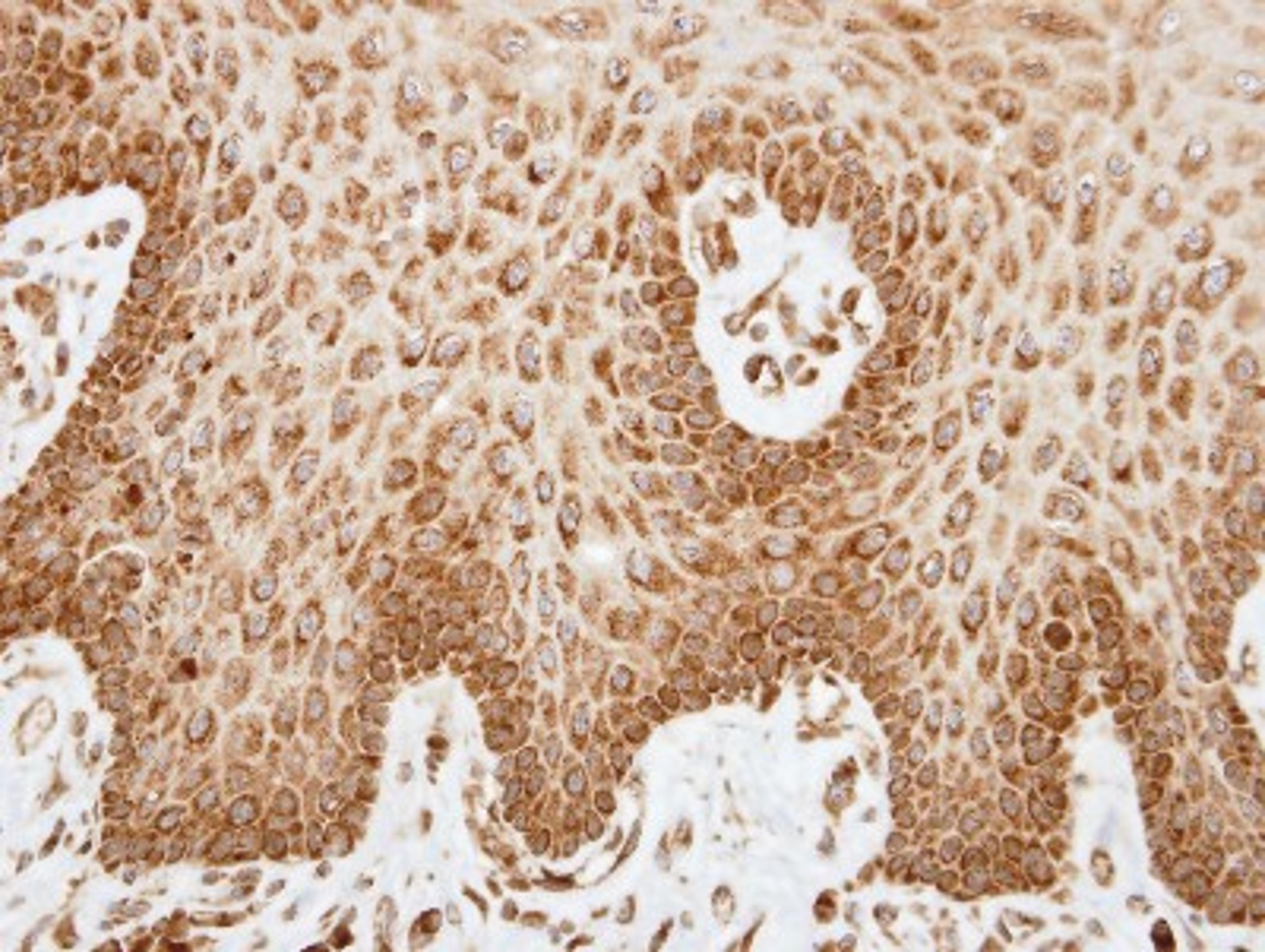 Immunohistochemistry-Paraffin: COX6A2 Antibody [NBP1-31112] - Paraffin-embedded SCC4 xenograft, using antibody at 1:100 dilution.