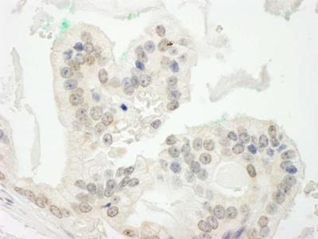 Immunohistochemistry: CBX6 Antibody [NBP1-28731] - FFPE section of human prostate carcinoma.  Antibody used at a dilution of 1:250. Detection: DAB staining using Immunohistochemistry Accessory Kit.