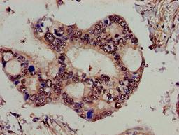 Immunohistochemistry of paraffin-embedded human pancreatic cancer using CSB-PA889158LA01HU at dilution of 1:100