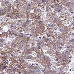 Immunohistochemistry: OR4A47 Antibody [NBP2-32493] - liver cancer