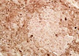 Immunohistochemical analysis of formalin-fixed paraffin embedded Human melanoma tissue using CITED1 antibody (dilution at 1:200)