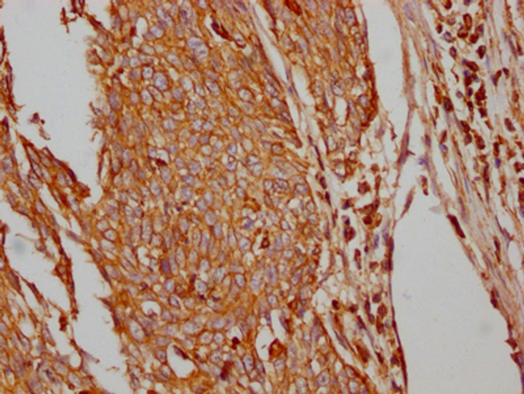 IHC image of CSB-RA297401A0HU diluted at 1:100 and staining in paraffin-embedded human cervical cancer performed on a Leica BondTM system. After dewaxing and hydration, antigen retrieval was mediated by high pressure in a citrate buffer (pH 6.0). Section was blocked with 10% normal goat serum 30min at RT. Then primary antibody (1% BSA) was incubated at 4℃ overnight. The primary is detected by a Goat anti-rabbit IgG polymer labeled by HRP and visualized using 0.05% DAB.