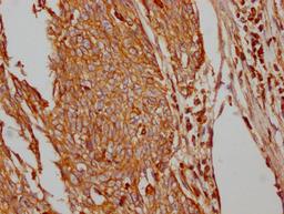 IHC image of CSB-RA297401A0HU diluted at 1:100 and staining in paraffin-embedded human cervical cancer performed on a Leica BondTM system. After dewaxing and hydration, antigen retrieval was mediated by high pressure in a citrate buffer (pH 6.0). Section was blocked with 10% normal goat serum 30min at RT. Then primary antibody (1% BSA) was incubated at 4℃ overnight. The primary is detected by a Goat anti-rabbit IgG polymer labeled by HRP and visualized using 0.05% DAB.