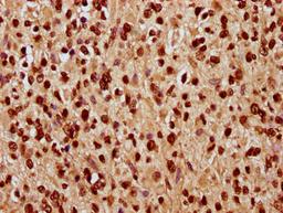 IHC image of CSB-PA010378OA168nhibHU diluted at 1:10 and staining in paraffin-embedded human glioma performed on a Leica BondTM system. After dewaxing and hydration, antigen retrieval was mediated by high pressure in a citrate buffer (pH 6.0). Section was blocked with 10% normal goat serum 30min at RT. Then primary antibody (1% BSA) was incubated at 4&deg;C overnight. The primary is detected by a biotinylated secondary antibody and visualized using an HRP conjugated SP system.