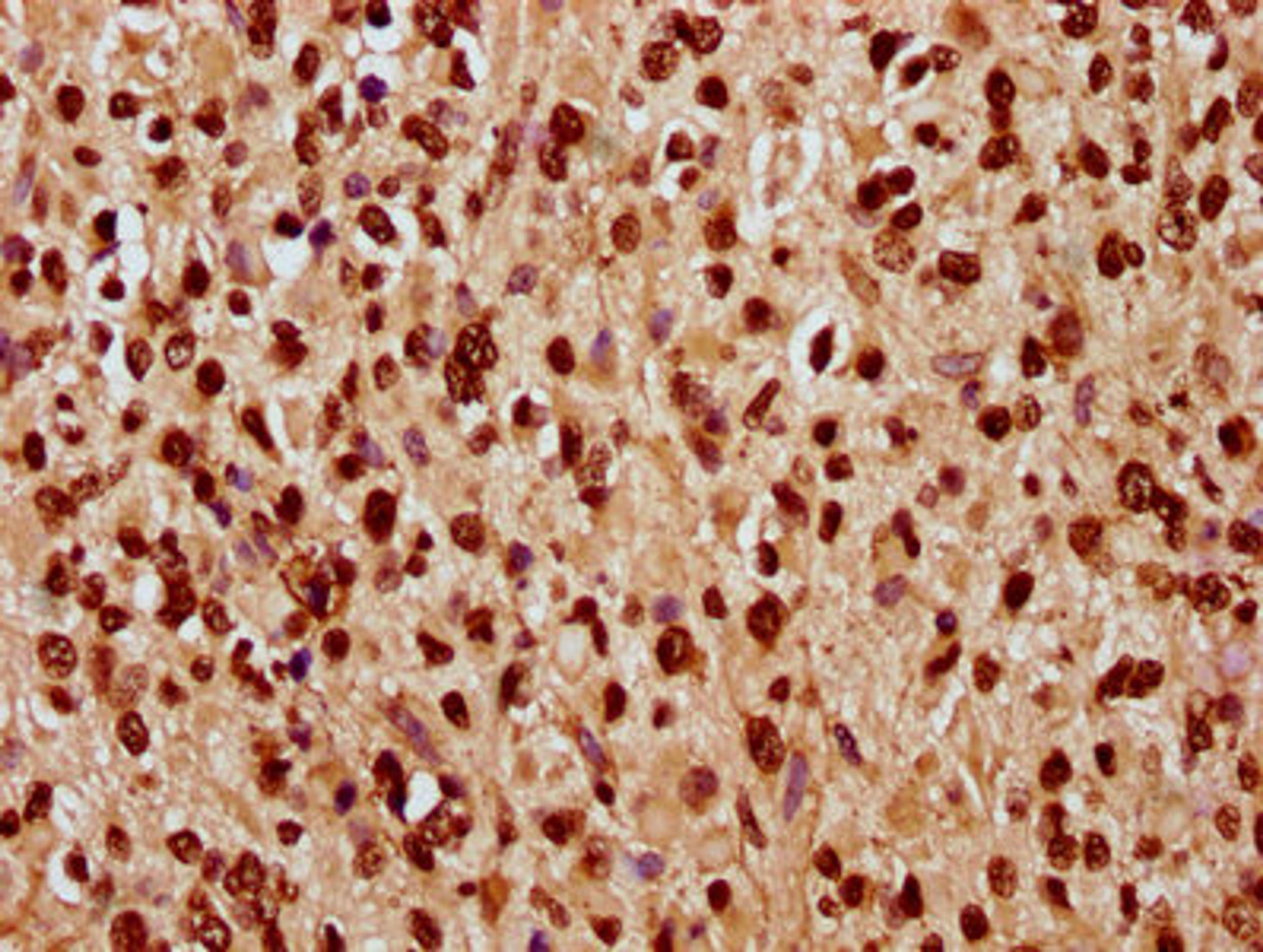 IHC image of CSB-PA010378OA168nhibHU diluted at 1:10 and staining in paraffin-embedded human glioma performed on a Leica BondTM system. After dewaxing and hydration, antigen retrieval was mediated by high pressure in a citrate buffer (pH 6.0). Section was blocked with 10% normal goat serum 30min at RT. Then primary antibody (1% BSA) was incubated at 4&deg;C overnight. The primary is detected by a biotinylated secondary antibody and visualized using an HRP conjugated SP system.
