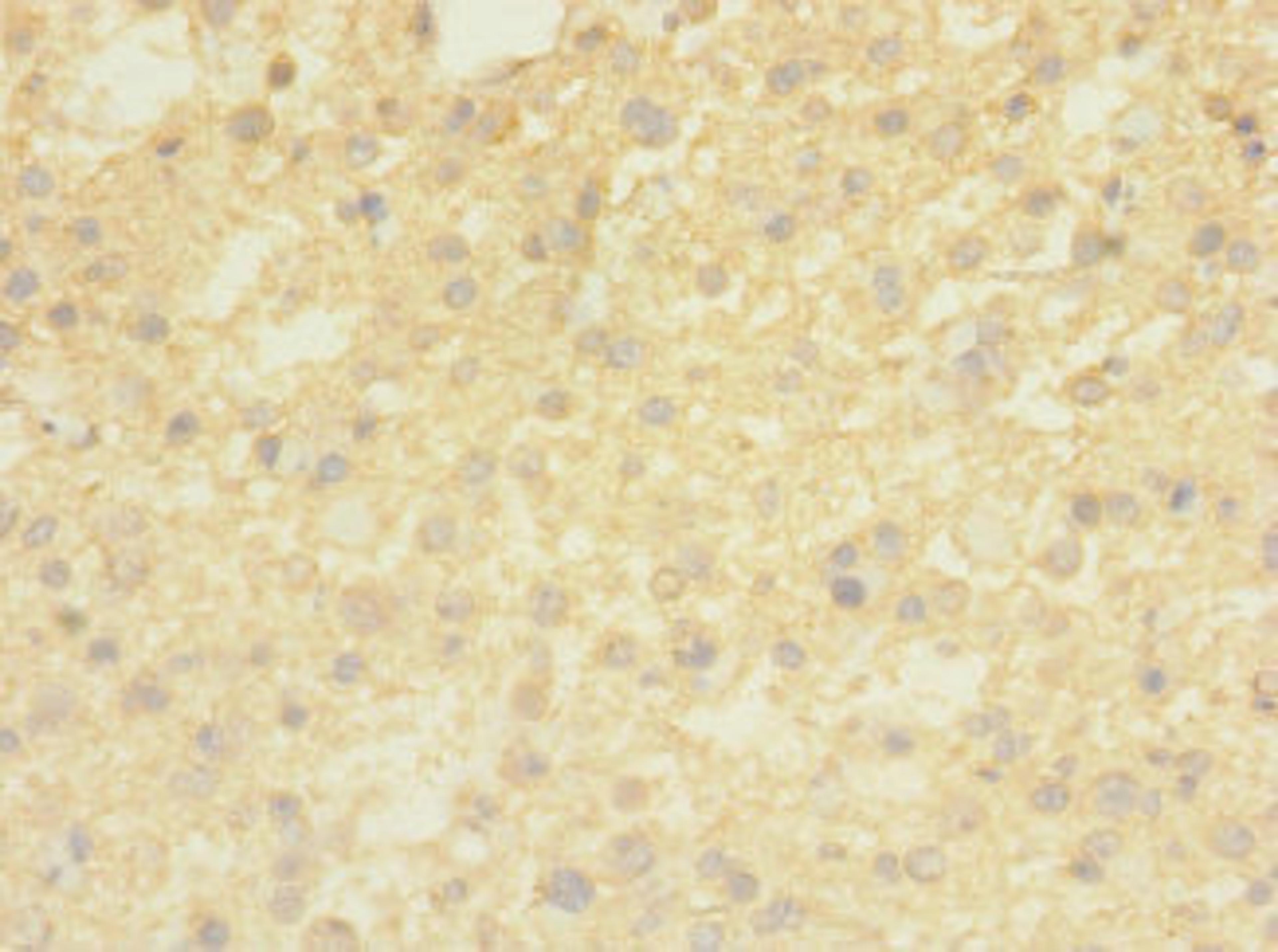 Immunohistochemistry of paraffin-embedded human glioma using CSB-PA023857LA01HU at dilution of 1:100