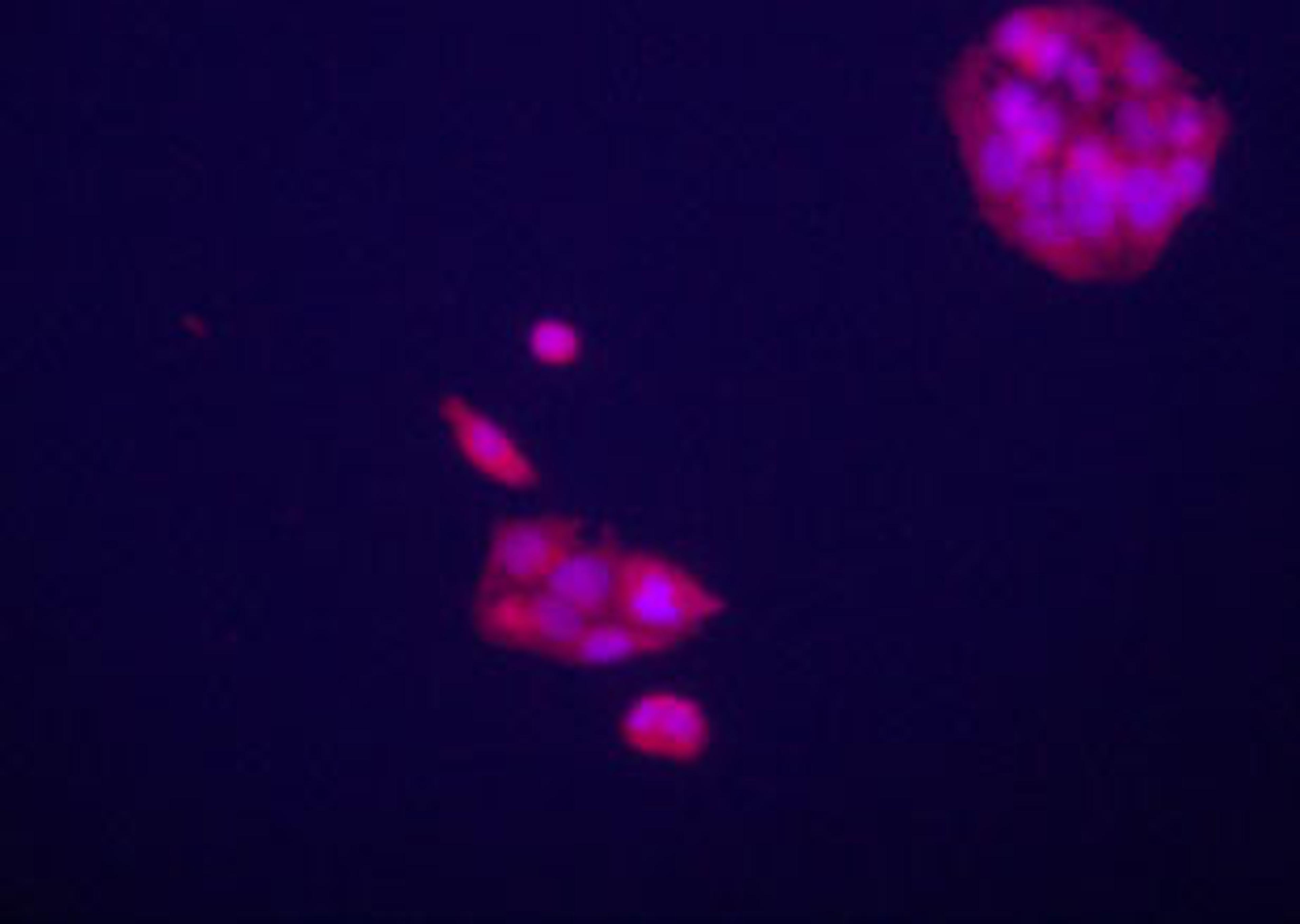 Immunofluorecence staining of anti-GPC3 Pab on HepG2 cells. The cells were acetone fixated. Antibody dilution of 1:50. Original magnification 1:400. Data and protocol courtesy of Dr. Mariana Dabeva, Department of Medicine at Albert Einstein College of Med