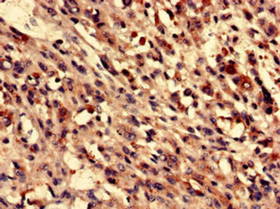 Immunohistochemistry analysis of human melanoma using CSB-PA883593LA01HU at dilution of 1:100