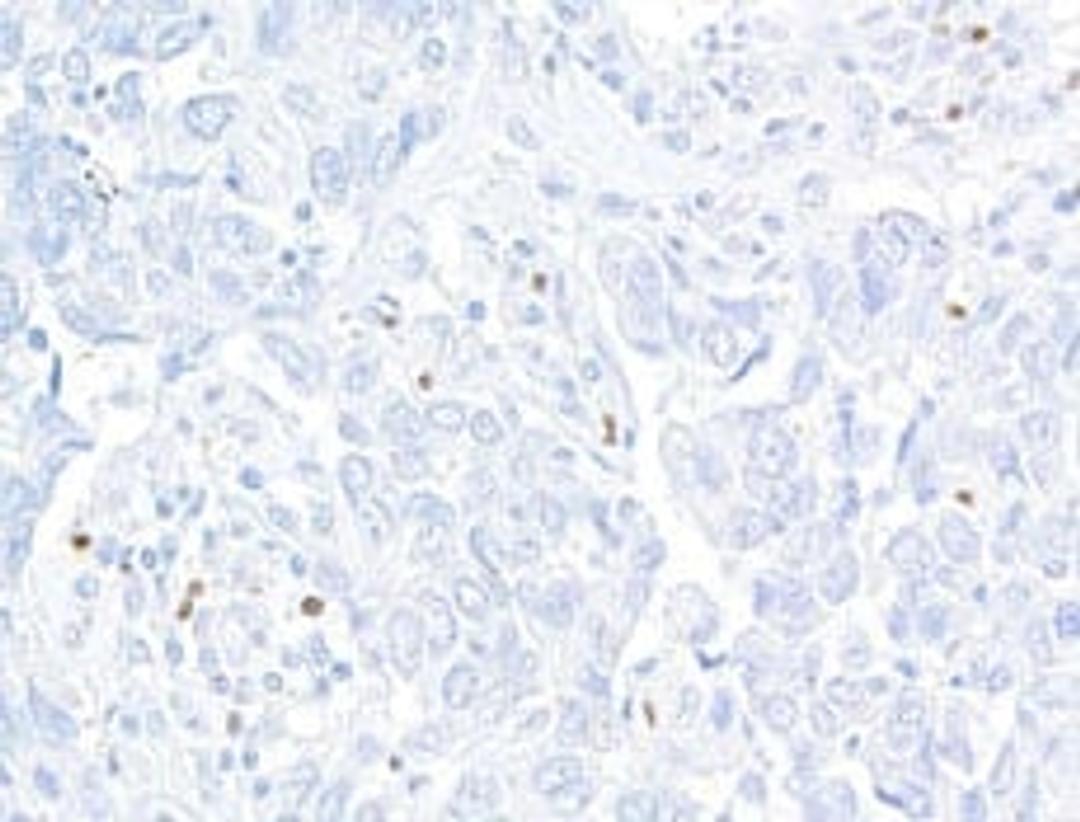 Detection of human FOXP3 in FFPE breast carcinoma by  immunohistochemistry.