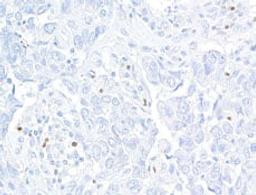 Detection of human FOXP3 in FFPE breast carcinoma by  immunohistochemistry.