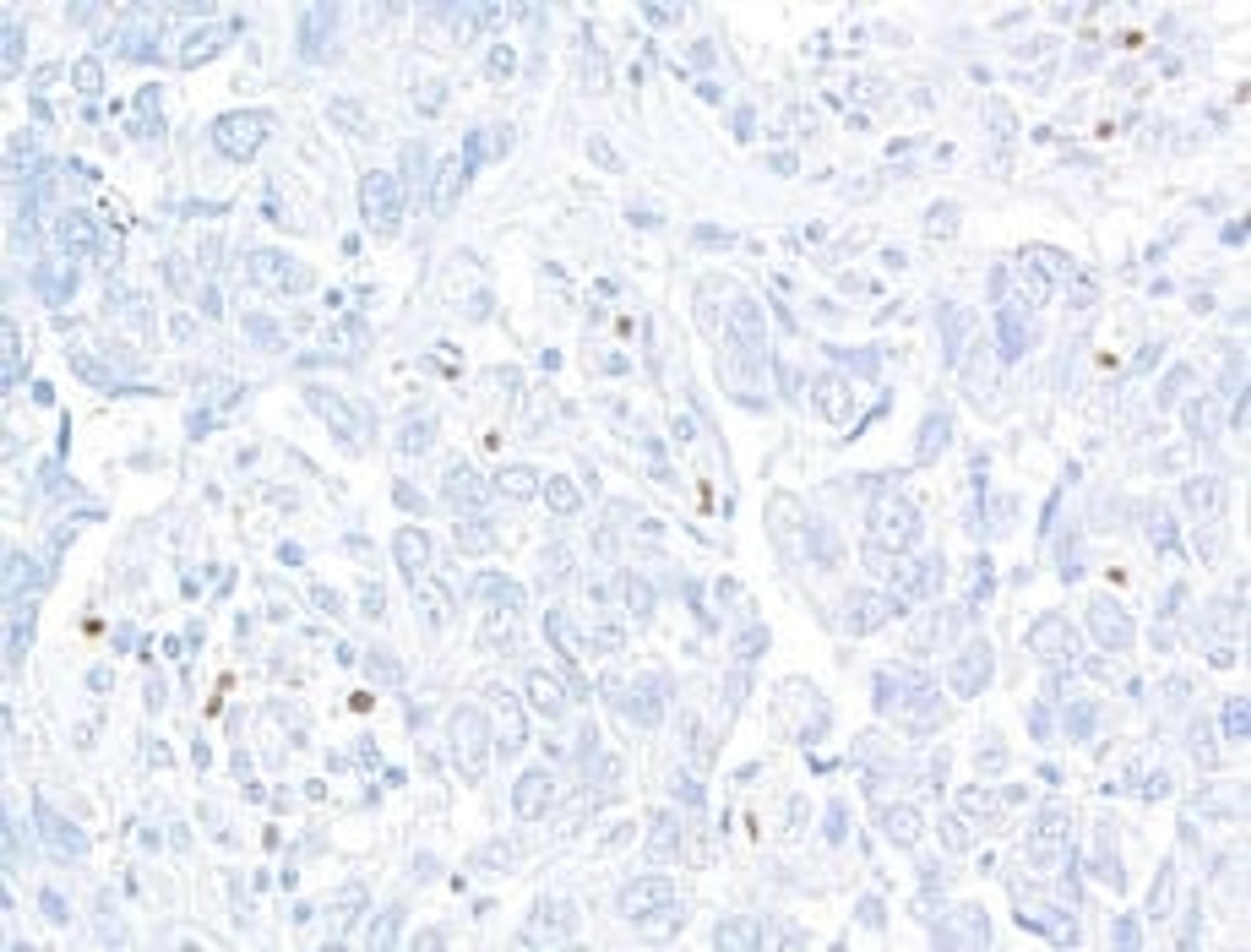 Detection of human FOXP3 in FFPE breast carcinoma by  immunohistochemistry.